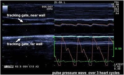 Comparison of Two Measurement Devices for Pulse Wave Velocity in Children: Which Tool Is Useful to Detect Vascular Alterations Caused by Overweight?